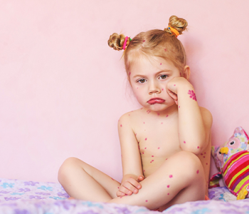 Bebe A La Varicelle Comment La Reconnaitre Et La Soigner La Boite Rose